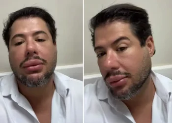 Hugo surge com rosto inchado após harmonização facial