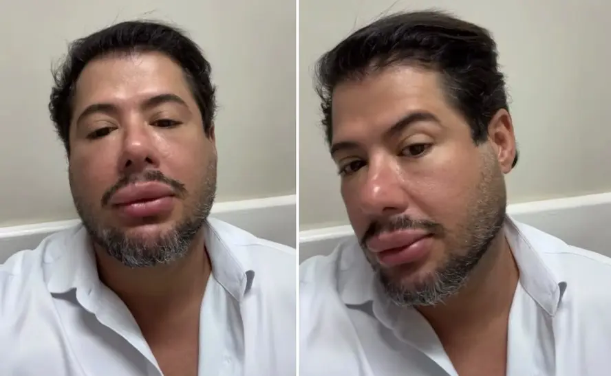 Hugo surge com rosto inchado após harmonização facial